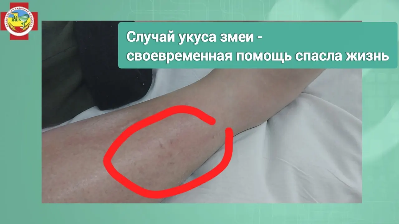 Жительницу Балашовского района доставили в больницу с укусом змеи в область лодыжки; женщина провела сутки в реанимации и сейчас идет на поправку.