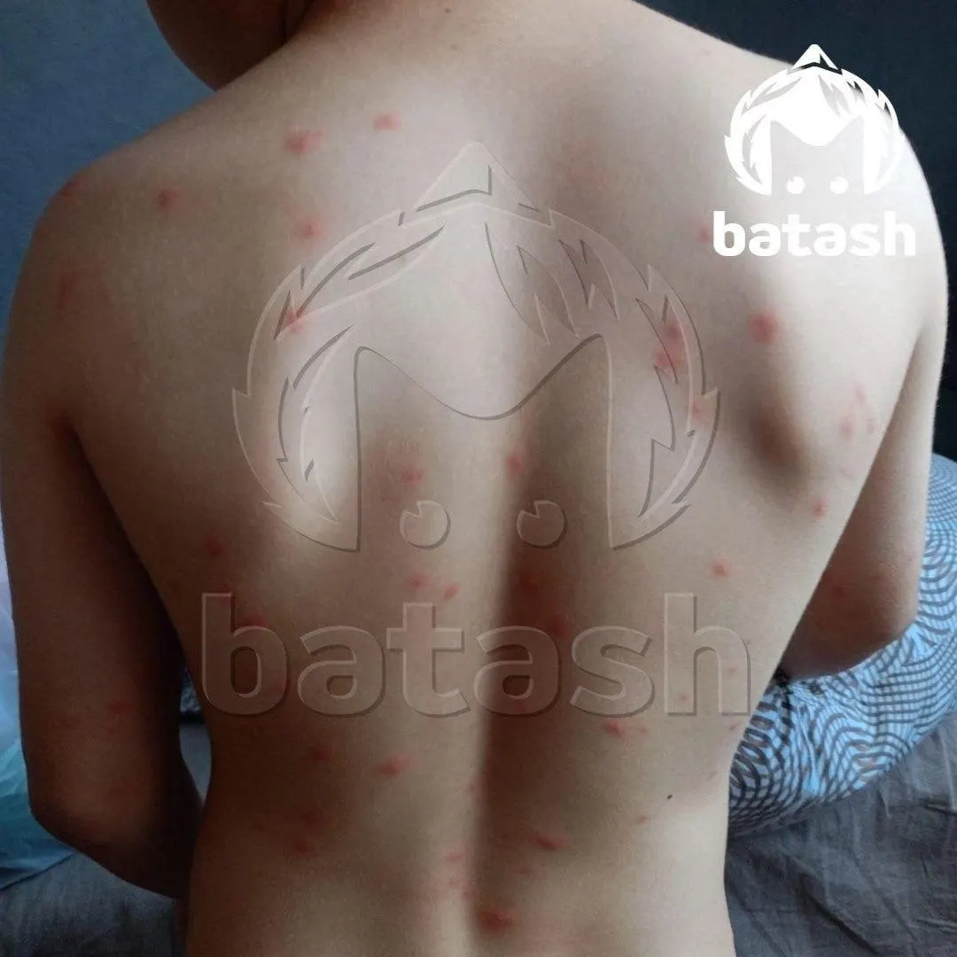 Мальчик покрылся чешущимися волдырями после купания в Кашкадане. В администрации Уфы называют инцидент единичным и подчёркивают необходимость установления точного диагноза.