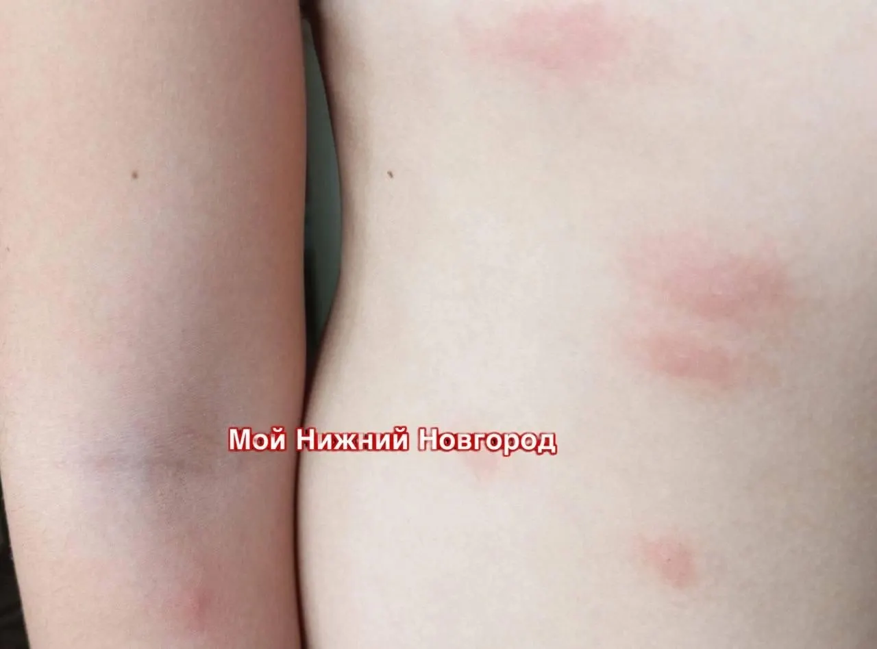 После купания у некоторых жителей, в том числе у ребёнка, появилась сыпь — возможный церкариоз. Роспотребнадзор разрешил купание, но направил пробы на проверку ветеринарным службам.